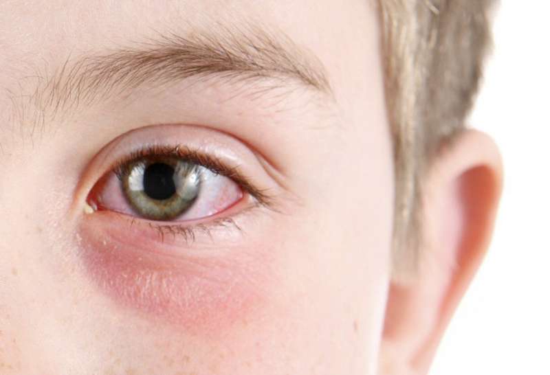 التهاب العين والإصابة بكورونا