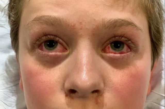 طفل يعاني من أعراض شديدة بعد إصابته بكورونا