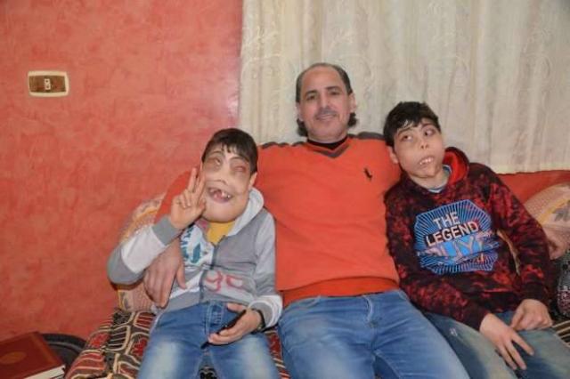 طفلا التضخم
