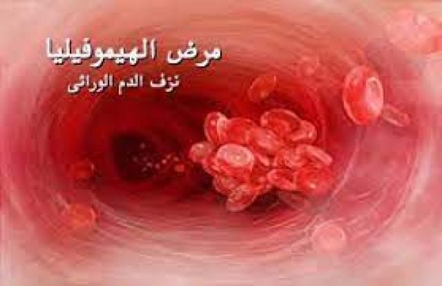 مرض الهيموفيليا