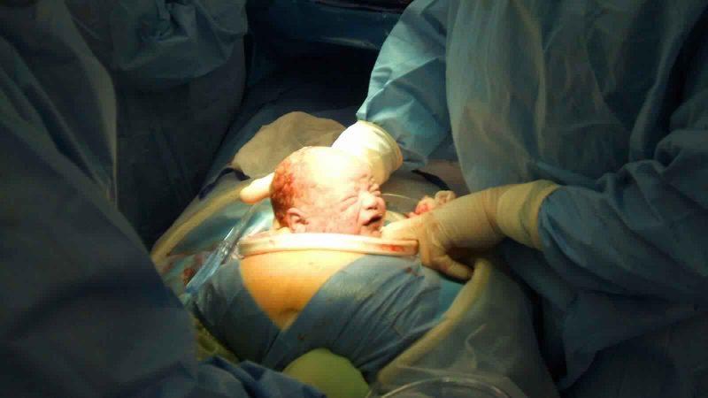 الولادة القيصرية 