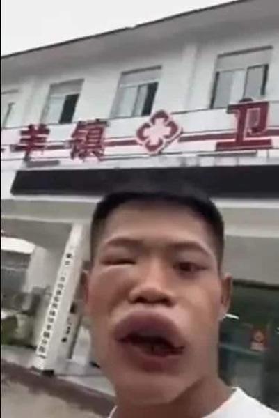 شاب صيني حاول أكل نحلة