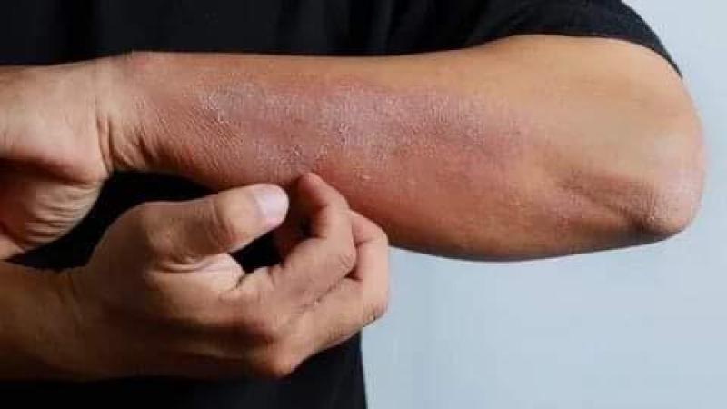 «الأكزيما» أبرزها.. 7 أعراض للطفح الجلدي وكيفية علاجه