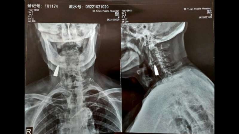  رصاصة داخل رقبة رجل صيني _ مصدر الصورة _ ViralPress