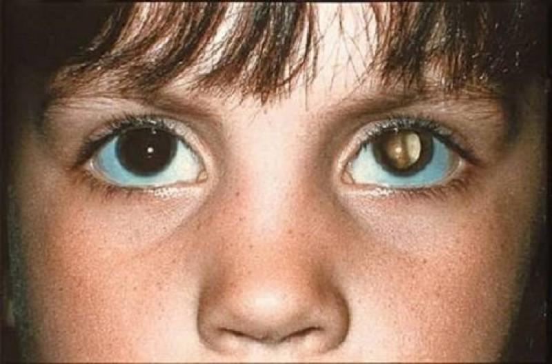 حقيقة الكشف عن أمراض العيون بواسطة ضوء «الفلاش» للموبايل.. فيديو