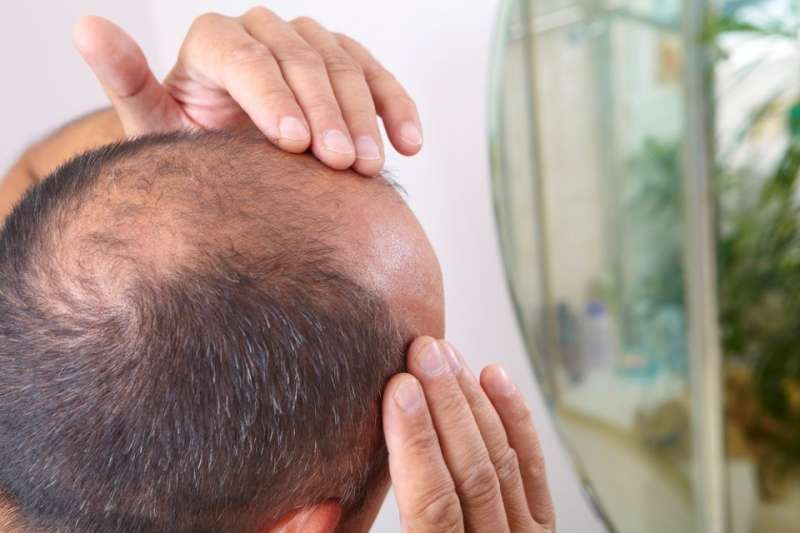 دراسة صينية تكشف أسباب تساقط الشعر عند الرجال بسبب المشروبات