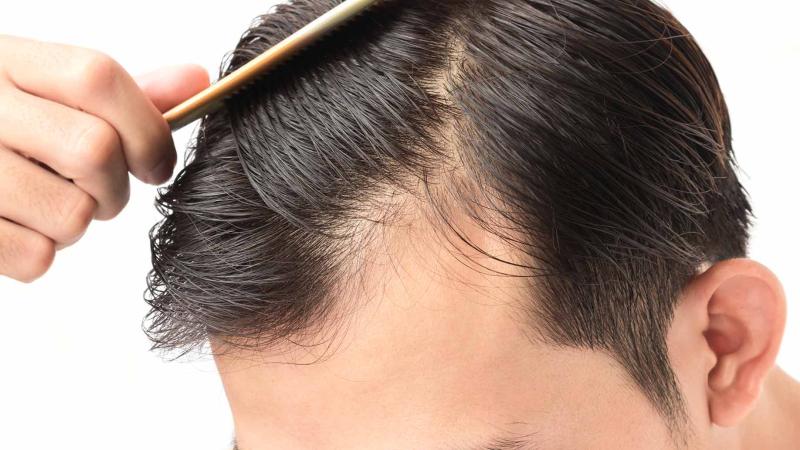 ”حافظ على شعرك”.. علاج تساقط الشعر لدى الرجل