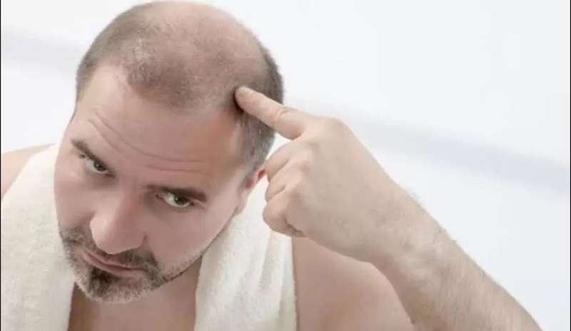 زراعة الشعر لدى الرجال.. تعرف على أشهر أنواعها