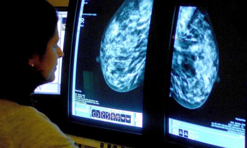 دراسة جديدة لمرضى سرطان الثدي_مصدر الصورة_ذا جارديان