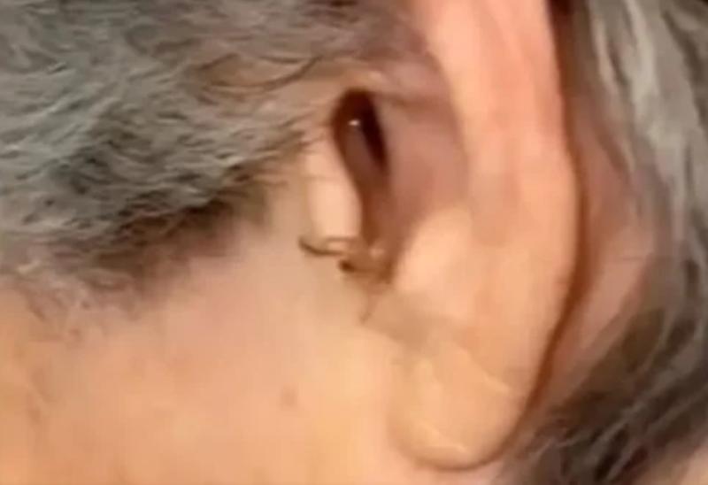 طبيب يثير الجدل بوجود صراصير داخل أذن مريض صيني
