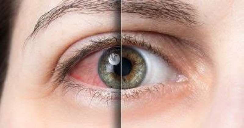 متلازمة جفاف العين 