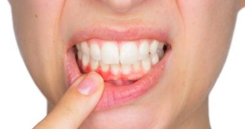 هل نظافة الأسنان والفم مرتبطة بصحة القلب؟.. استشاري يجيب