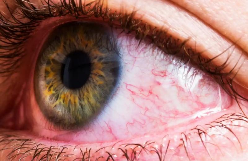4 أعراض في العين تكشف عن إصابتك بالخرف.. منها صعوبة القراءة