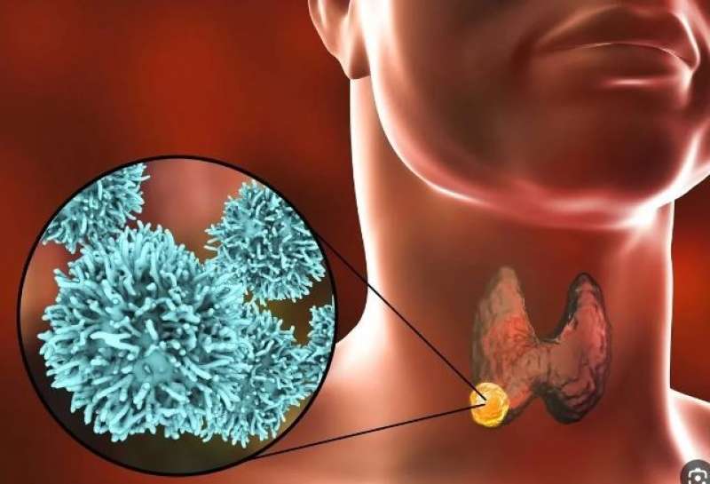 الصحة: سرطان الغدد الليمفاوية يشكل 10% من إجمالي حالات الأورام