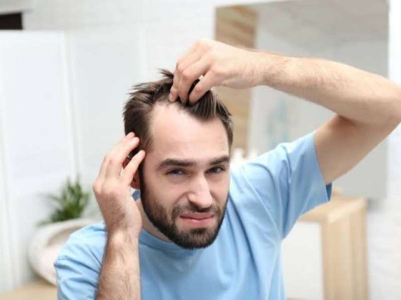منها تساقط الشعر.. 4 علامات تشير للإصابة بمشكلة الصلع الذكوري