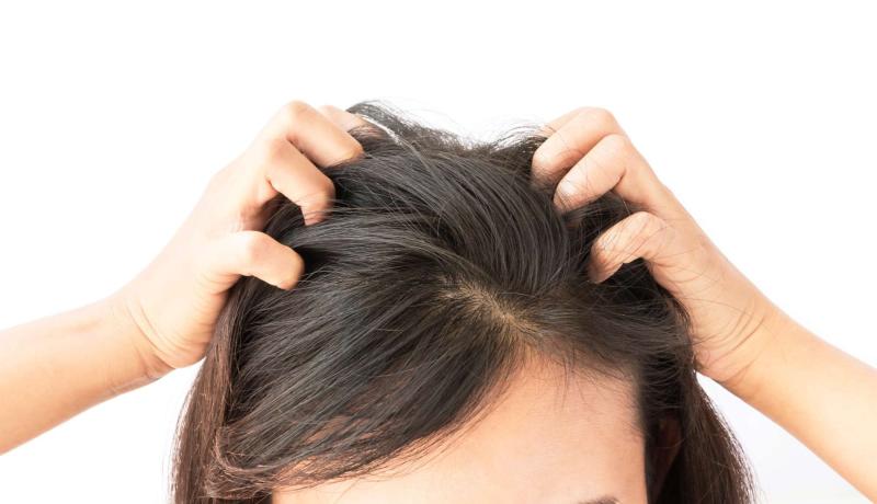 أسباب وطرق علاج مثالية لـ قشرة الشعر في المنزل