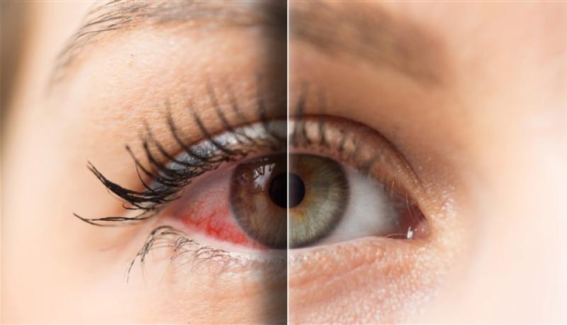 جفاف العين خطر يهدد نعمة البصر