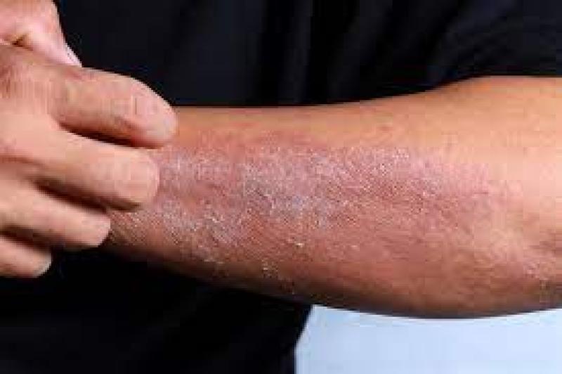 ما هي الأمراض الجلدية الصيفية وكيفية الوقاية منها؟