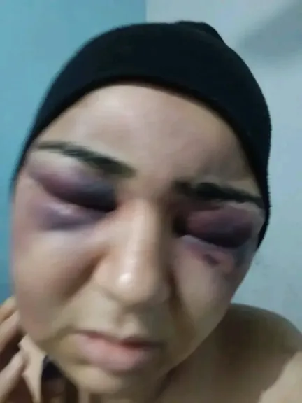 أصابها إصابات بالغة.. زوج يعتدي بالضرب على زوجته في الفيوم