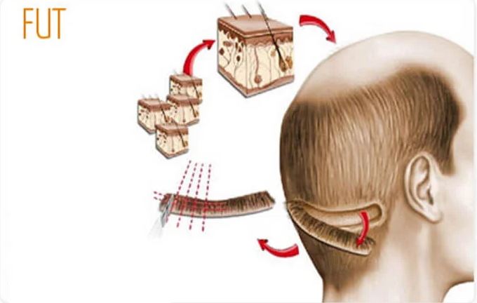 زراعة الشعر بوحدة الشريط FUT