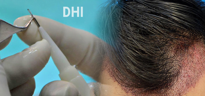 زراعة الشعر المباشر DHI